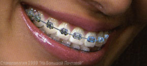brakets_metall_teeth[1].jpg
