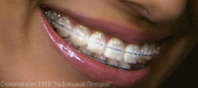 brakets_sapfir_teeth[1].jpg
